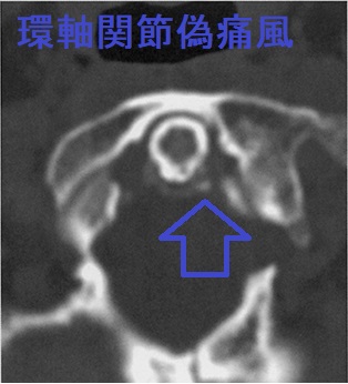 環軸関節偽痛風 CT画像(水平断) 環軸関節偽痛風 CT画像(水平断)