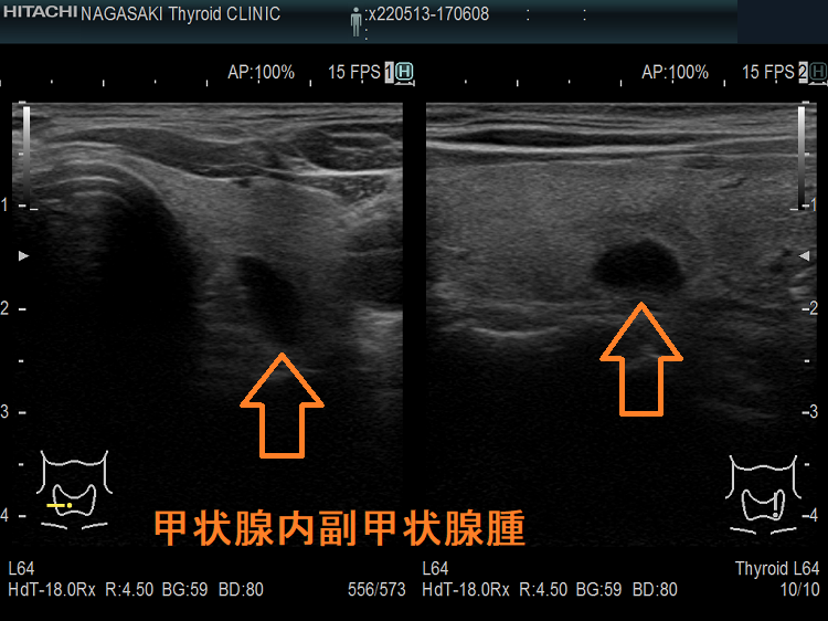 甲状腺内副甲状腺腫 超音波(エコー)画像 甲状腺内副甲状腺腫 超音波(エコー)画像
