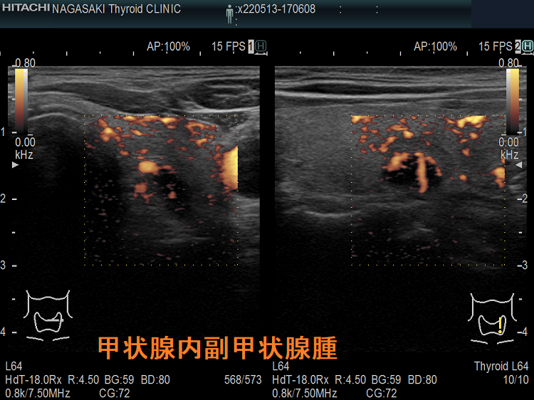 甲状腺内副甲状腺腫 ドプラー 甲状腺内副甲状腺腫 ドプラー