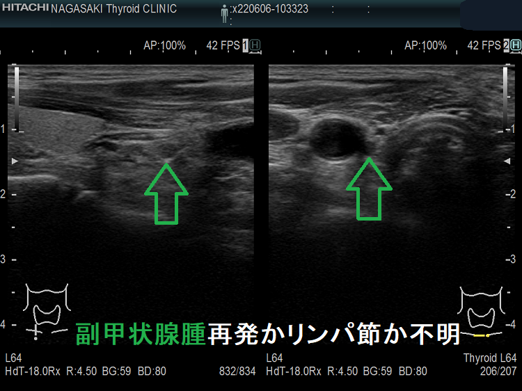 副甲状腺腺腫の取り残しか、副甲状腺癌の再発か、リンパ節か不明 副甲状腺腺腫の取り残しか、副甲状腺癌の再発か、リンパ節か不明