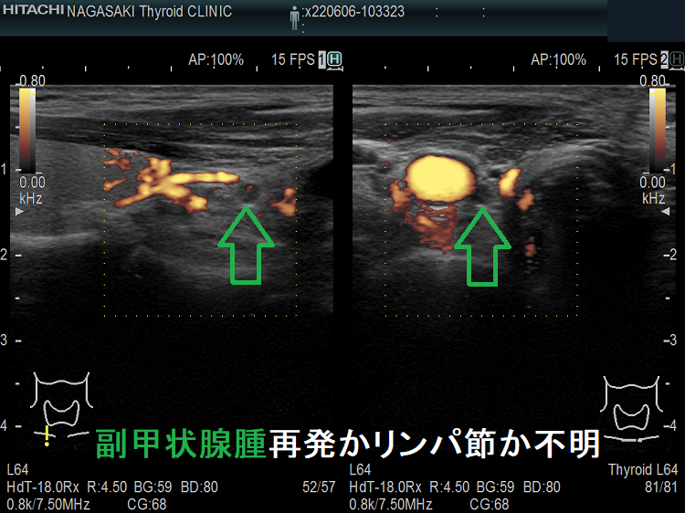 副甲状腺腺腫の取り残しか、副甲状腺癌の再発か、リンパ節か不明 ドプラーモード 副甲状腺腺腫の取り残しか、副甲状腺癌の再発か、リンパ節か不明 ドプラーモード