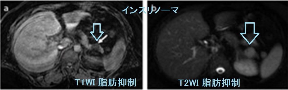 インスリノーマ 単純MRI T1WI T2WI インスリノーマ 単純MRI T1WI T2WI