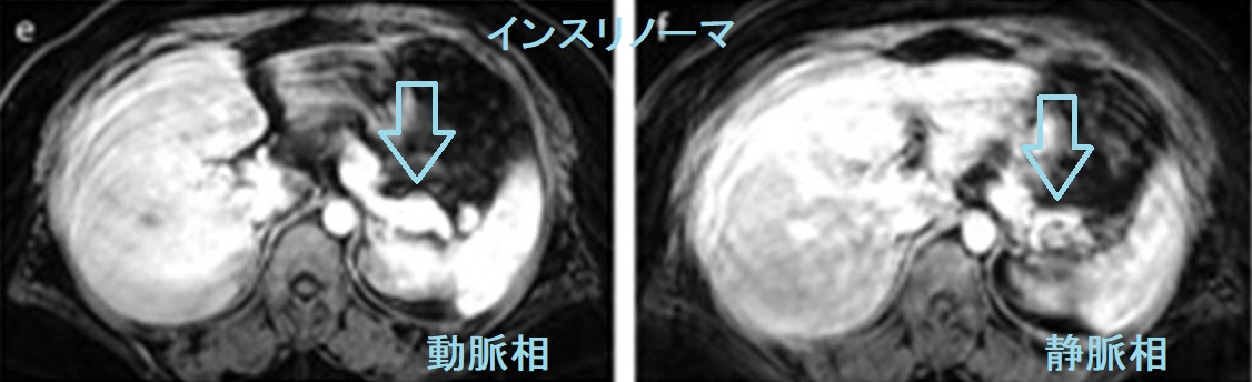 インスリノーマ ダイナミックMRI 動脈相 静脈相 インスリノーマ ダイナミックMRI 動脈相 静脈相