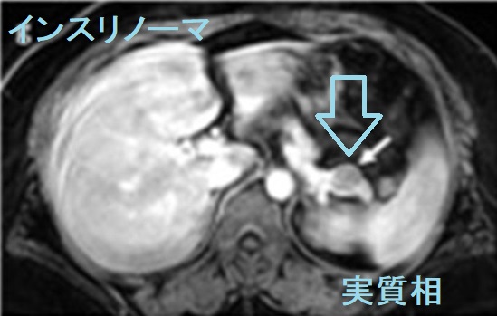 インスリノーマ ダイナミックMRI 実質相 インスリノーマ ダイナミックMRI 実質相