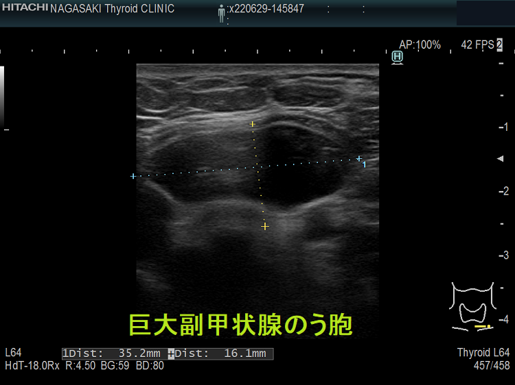 巨大副甲状腺のう胞 (超音波エコー画像 水平断) 巨大副甲状腺のう胞 (超音波エコー画像 水平断)