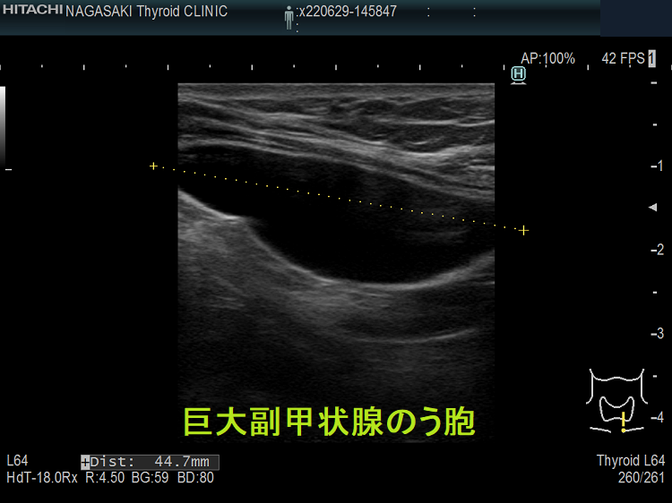 巨大副甲状腺のう胞 (超音波エコー画像 垂直断) 巨大副甲状腺のう胞 (超音波エコー画像 垂直断)