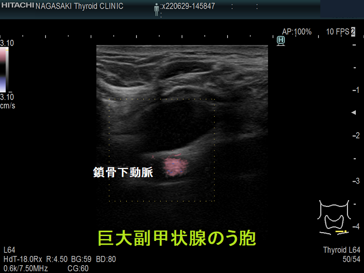 巨大副甲状腺のう胞 (超音波エコー画像 水平断) 巨大副甲状腺のう胞 (超音波エコー画像 水平断)