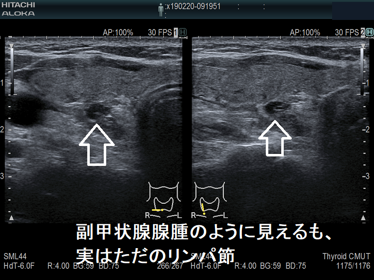 副甲状腺腺腫のように見えるも、実はただのリンパ節 副甲状腺腺腫のように見えるも、実はただのリンパ節