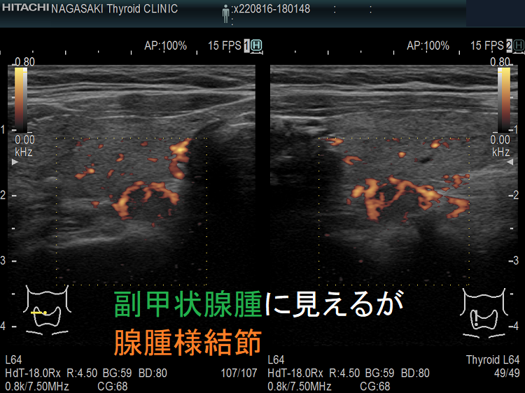 副甲状腺腺腫に見えるが甲状腺腺腫様結節 超音波(エコー)画像 ドプラーモード 副甲状腺腺腫に見えるが甲状腺腺腫様結節 超音波(エコー)画像 ドプラーモード