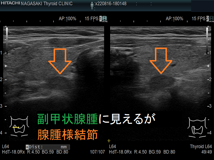 副甲状腺腺腫に見えるが甲状腺腺腫様結節 超音波(エコー)画像 副甲状腺腺腫に見えるが甲状腺腺腫様結節 超音波(エコー)画像
