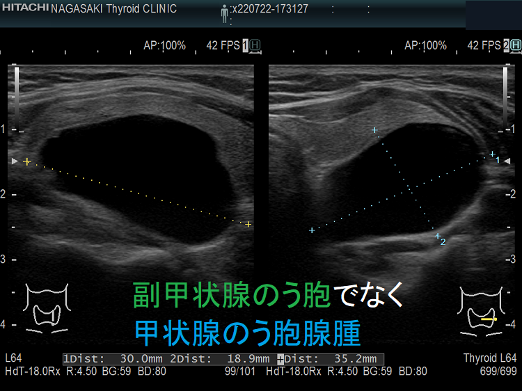 副甲状腺のう胞でなく甲状腺のう胞腺腫 超音波(エコー)画像 副甲状腺のう胞でなく甲状腺のう胞腺腫 超音波(エコー)画像