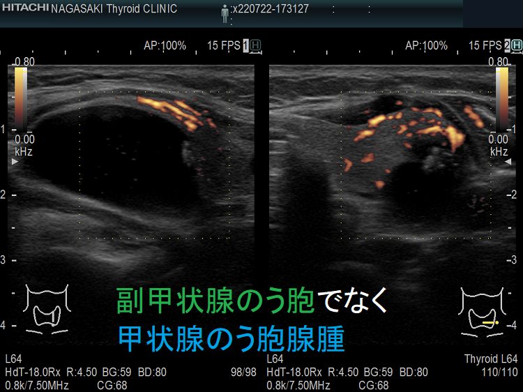 副甲状腺のう胞でなく甲状腺のう胞腺腫 超音波(エコー)画像 ドプラーモード 副甲状腺のう胞でなく甲状腺のう胞腺腫 超音波(エコー)画像 ドプラーモード