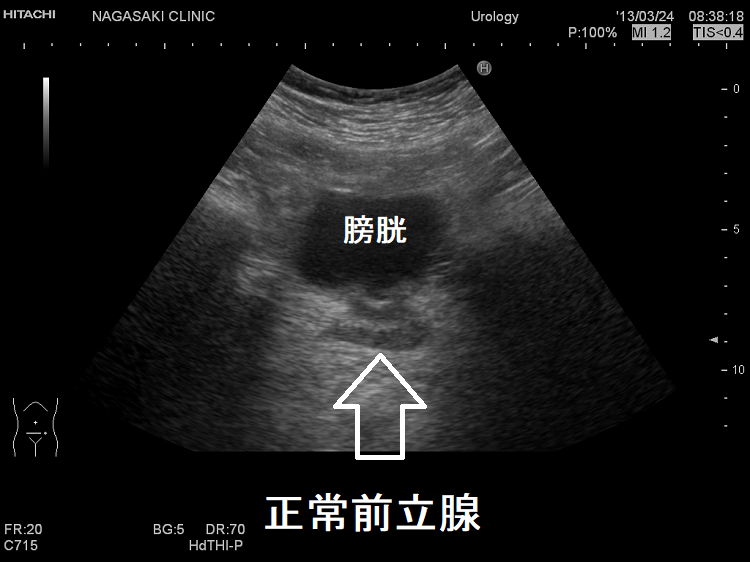 前立腺と甲状腺・副甲状腺(前立腺肥大・前立腺がん) 前立腺と甲状腺・副甲状腺(前立腺肥大・前立腺がん)