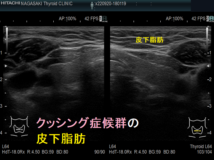 クッシング症候群の皮下脂肪 超音波(エコー)画像 クッシング症候群の皮下脂肪 超音波(エコー)画像
