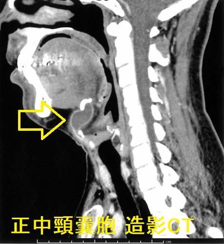 正中頸嚢胞 造影CT画像(矢状断) 正中頸嚢胞 造影CT画像(矢状断)
