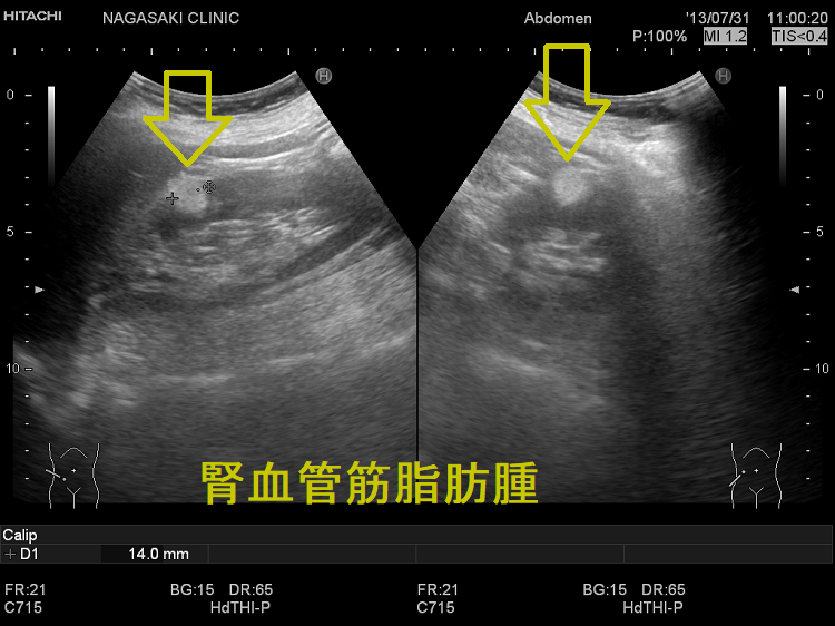 腎血管筋脂肪腫 超音波(エコー)画像 腎血管筋脂肪腫 超音波(エコー)画像