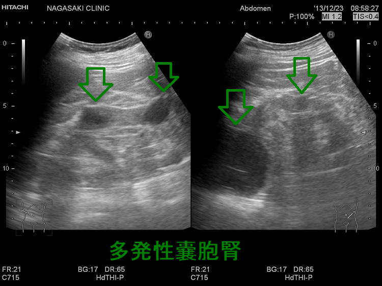 多発性腎嚢胞 超音波(エコー)画像2 多発性腎嚢胞 超音波(エコー)画像2