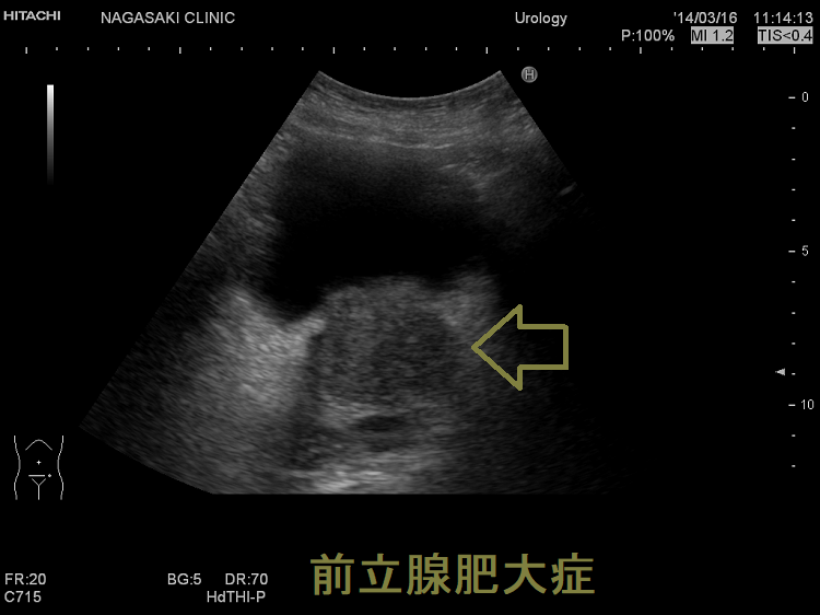 前立腺肥大症 前立腺肥大症