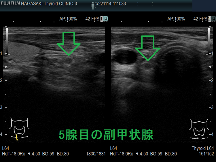 5腺目の副甲状腺 5腺目の副甲状腺
