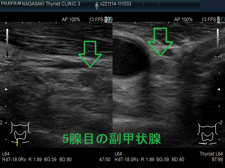 5腺目の副甲状腺(拡大) 5腺目の副甲状腺(拡大)