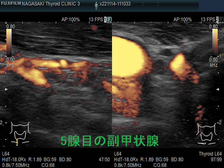 5腺目の副甲状腺(拡大)ドプラーモード 5腺目の副甲状腺(拡大)ドプラーモード