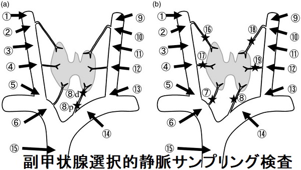 副甲状腺選択的静脈サンプリング検査 副甲状腺選択的静脈サンプリング検査