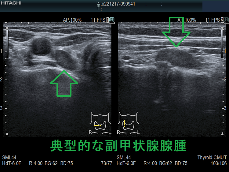 典型的な副甲状腺腺腫 超音波(エコー)画像 2 典型的な副甲状腺腺腫 超音波(エコー)画像 2