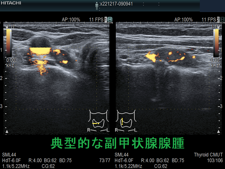 典型的な副甲状腺腺腫 超音波(エコー)画像 ドプラーモード 典型的な副甲状腺腺腫 超音波(エコー)画像 ドプラーモード