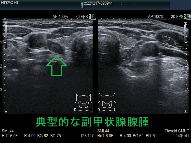 典型的な副甲状腺腺腫 超音波(エコー)画像 典型的な副甲状腺腺腫 超音波(エコー)画像