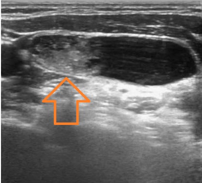 頸部異所性のう胞型腺腫様結節2 頸部異所性のう胞型腺腫様結節2