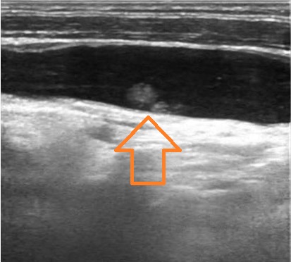 頸部異所性のう胞型腺腫様結節 頸部異所性のう胞型腺腫様結節1