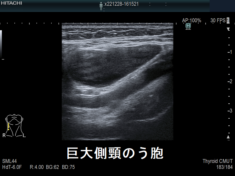 巨大側頸のう胞 超音波(エコー)画像1 巨大側頸のう胞 超音波(エコー)画像1
