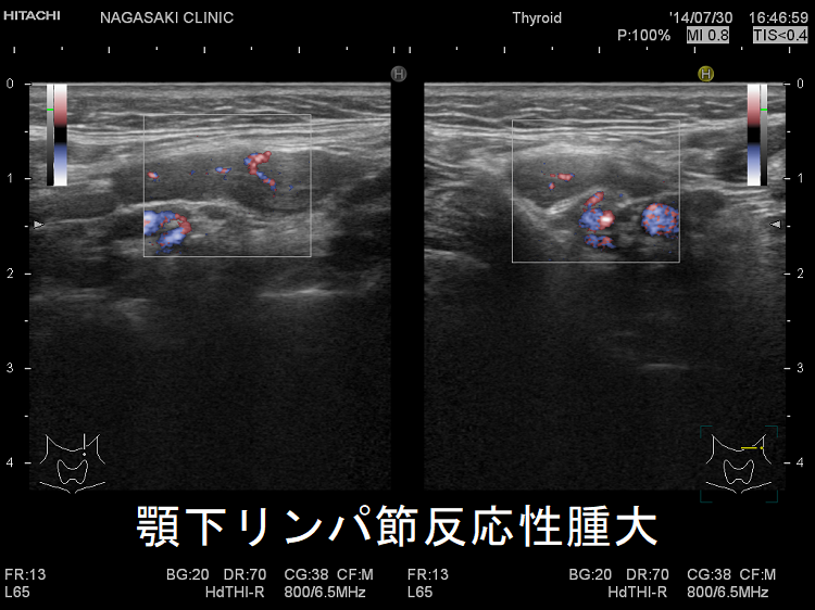 顎下リンパ節反応性腫大 ドプラーモード 顎下リンパ節反応性腫大 ドプラーモード