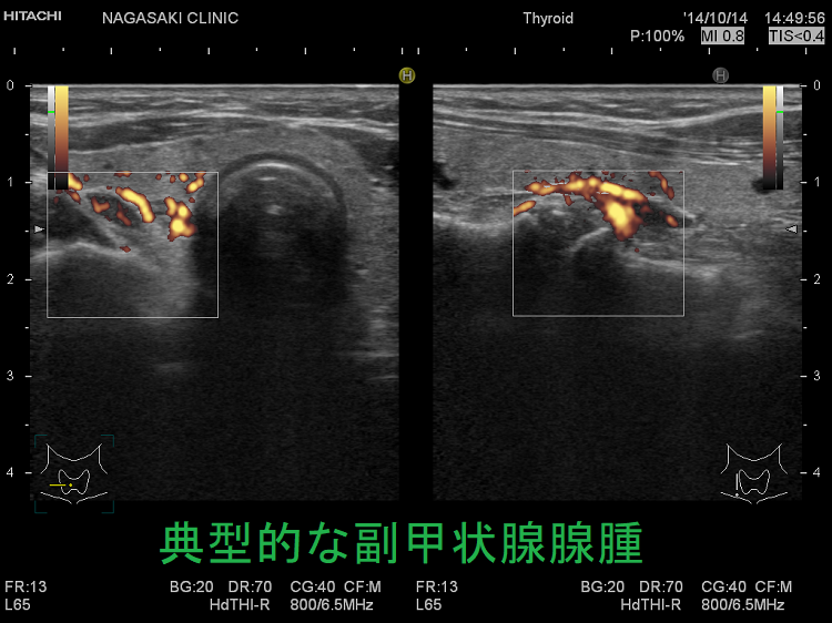 典型的な副甲状腺腺腫 超音波(エコー)画像 典型的な副甲状腺腺腫 超音波(エコー)画像