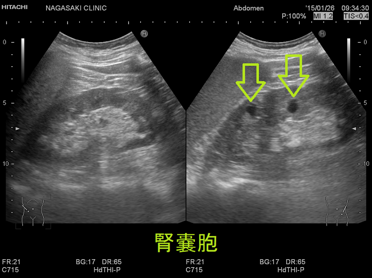 腎嚢胞 腎嚢胞