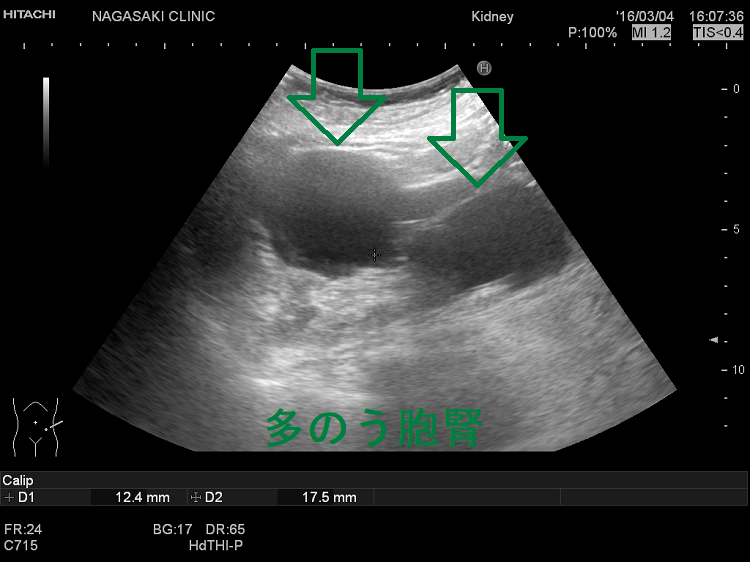 多発性腎嚢胞 超音波(エコー)画像 左腎 多発性腎嚢胞 超音波(エコー)画像 左腎