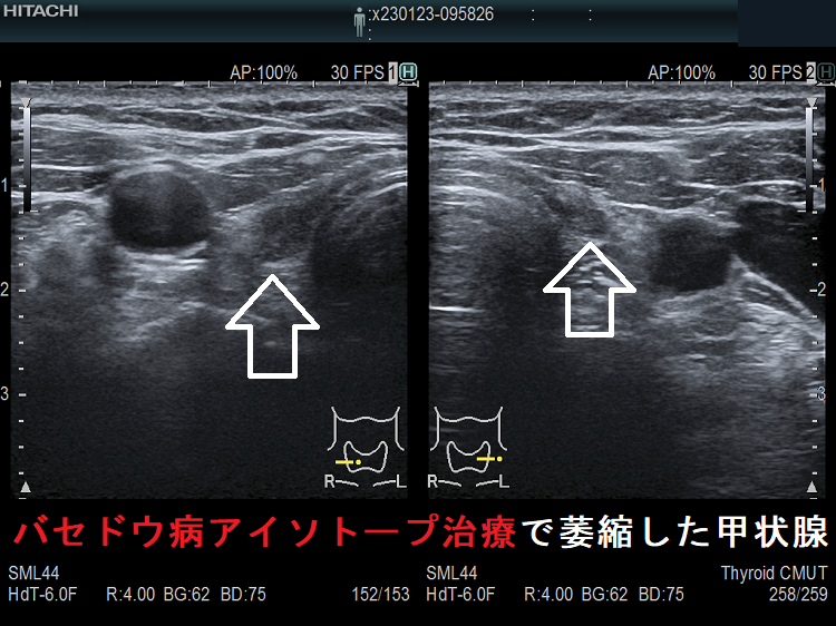 バセドウ病アイソトープ治療後で萎縮した甲状腺 超音波エコー画像 バセドウ病アイソトープ治療後で萎縮した甲状腺 超音波エコー画像
