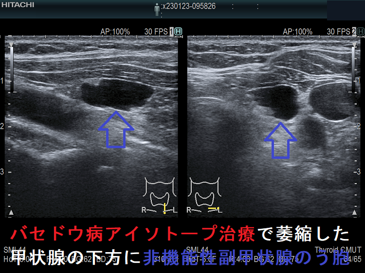 バセドウ病アイソトープ治療後で萎縮した甲状腺の下方に非機能性副甲状腺のう胞 バセドウ病アイソトープ治療後で萎縮した甲状腺の下方に非機能性副甲状腺のう胞