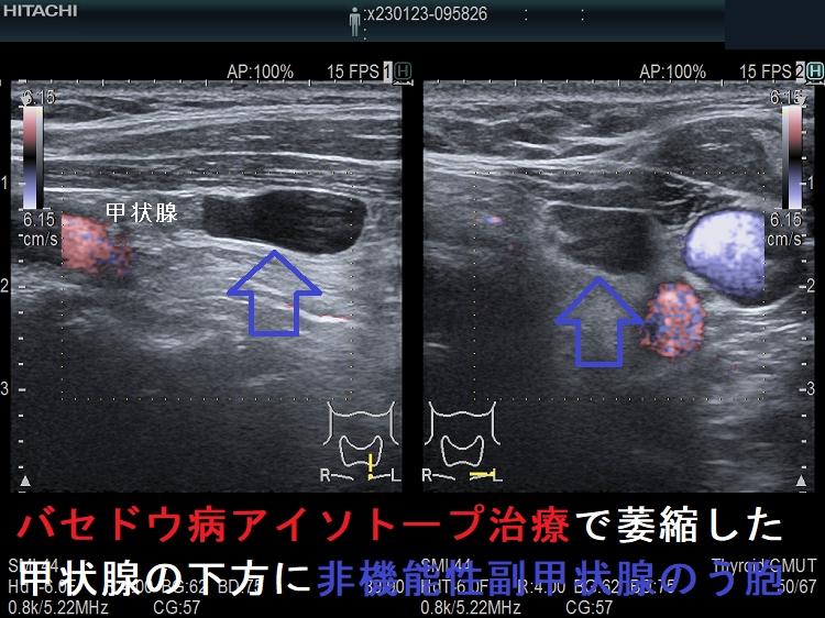 バセドウ病アイソトープ治療後で萎縮した甲状腺の下方に非機能性副甲状腺のう胞 ドプラーモード バセドウ病アイソトープ治療後で萎縮した甲状腺の下方に非機能性副甲状腺のう胞 ドプラーモード