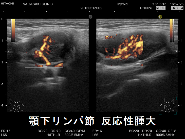 顎下リンパ節反応性腫大 ドプラーモード 顎下リンパ節 反応性腫大 超音波(エコー)画像 ドプラーモード3