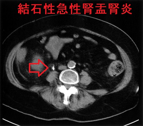 結石性急性腎盂腎炎 CT画像 結石性急性腎盂腎炎 CT画像