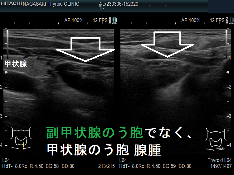 副甲状腺のう胞でなく甲状腺のう胞腺腫 副甲状腺のう胞でなく甲状腺のう胞腺腫