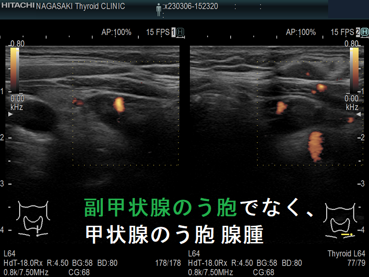 副甲状腺のう胞でなく甲状腺のう胞腺腫 ドプラーモード 副甲状腺のう胞でなく甲状腺のう胞腺腫 ドプラーモード