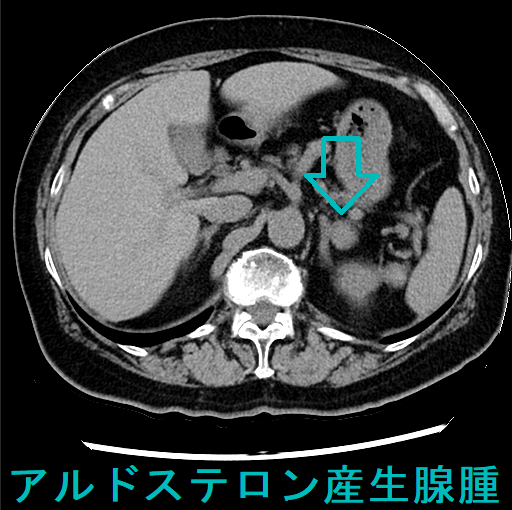 アルドステロン産生腺腫 CT画像 アルドステロン産生腺腫 CT画像