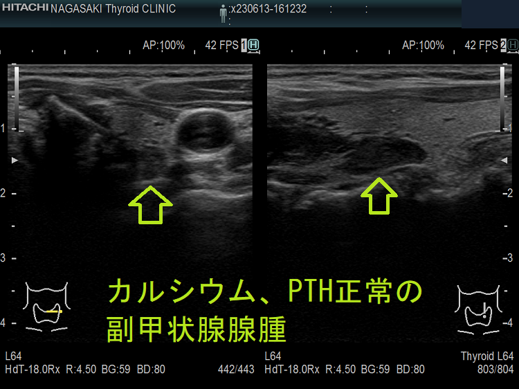 血清カルシウム・リン・副甲状腺ホルモン(PTH)濃度正常の副甲状腺腺腫 血清カルシウム・リン・副甲状腺ホルモン(PTH)濃度正常の副甲状腺腺腫