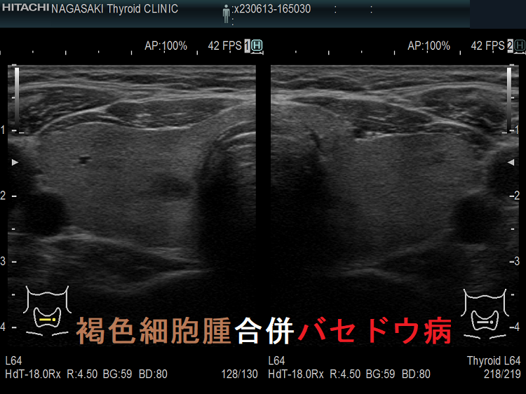 褐色細胞腫合併バセドウ病 褐色細胞腫合併バセドウ病