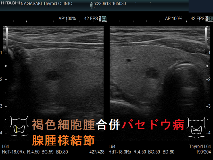 褐色細胞腫合併バセドウ病 腺腫様結節 褐色細胞腫合併バセドウ病 腺腫様結節