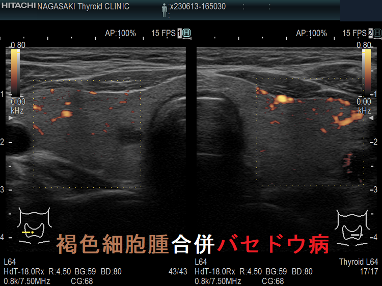 褐色細胞腫合併バセドウ病 ドプラーモード 褐色細胞腫合併バセドウ病 ドプラーモード