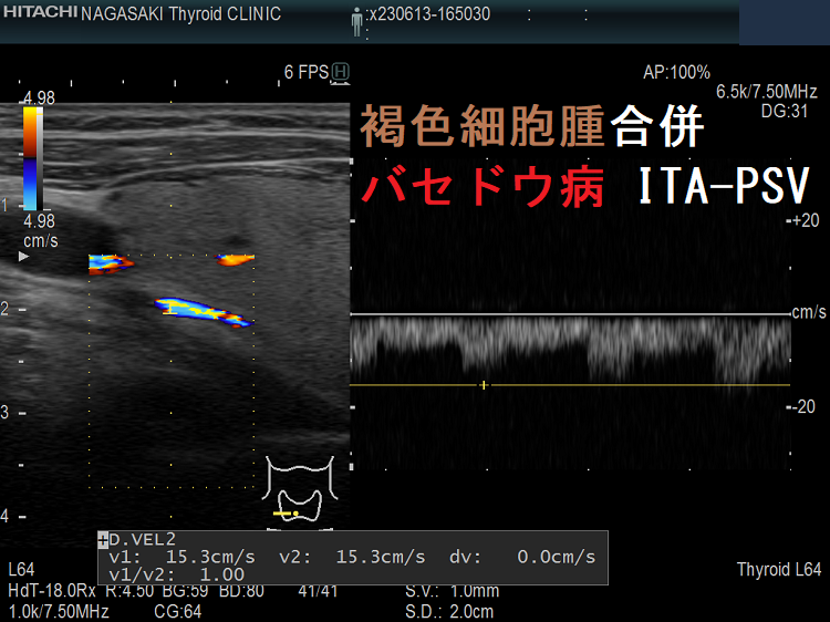 褐色細胞腫合併バセドウ病 ITA-PSV 褐色細胞腫合併バセドウ病 ITA-PSV