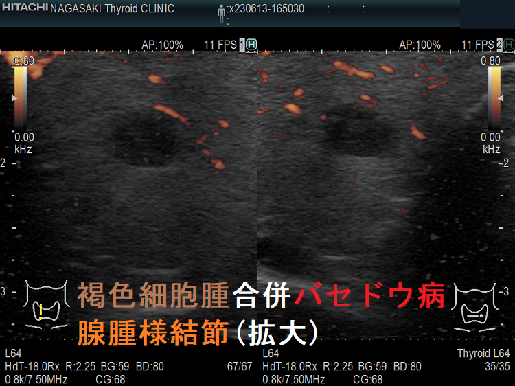 褐色細胞腫合併バセドウ病 腺腫様結節(拡大) 褐色細胞腫合併バセドウ病 腺腫様結節(拡大)